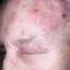 19. Shingles on Face Pictures