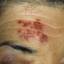 2. Shingles on Face Pictures