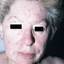 5. Shingles on Face Pictures