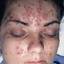 6. Shingles on Face Pictures