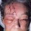 9. Shingles on Face Pictures