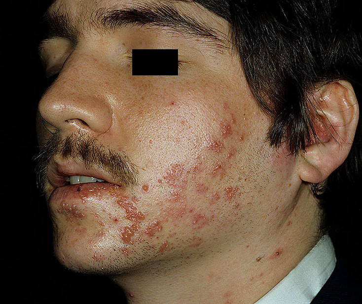 List 96 Pictures Photos Of Shingles On Face Excellent