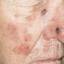14. Medical Shingles Pictures