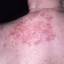 15. Medical Shingles Pictures