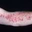 16. Medical Shingles Pictures