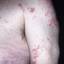 17. Medical Shingles Pictures
