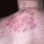 34. Medical Shingles Pictures