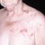 36. Medical Shingles Pictures