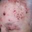 40. Medical Shingles Pictures