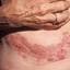 42. Medical Shingles Pictures
