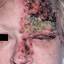 49. Medical Shingles Pictures