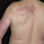 5. Medical Shingles Pictures