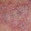 7. Medical Shingles Pictures