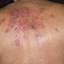 8. Medical Shingles Pictures