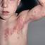 11. Shingles in Children Pictures