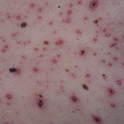 What is Chicken Pox