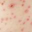 12. What is Chicken Pox Pictures