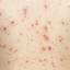 17. What is Chicken Pox Pictures