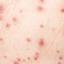 18. What is Chicken Pox Pictures
