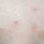 3. What is Chicken Pox Pictures