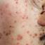 6. What is Chicken Pox Pictures