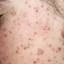 8. What is Chicken Pox Pictures