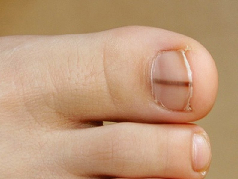 Dark Colored Nail Beds and Skin Cancer - wide 5