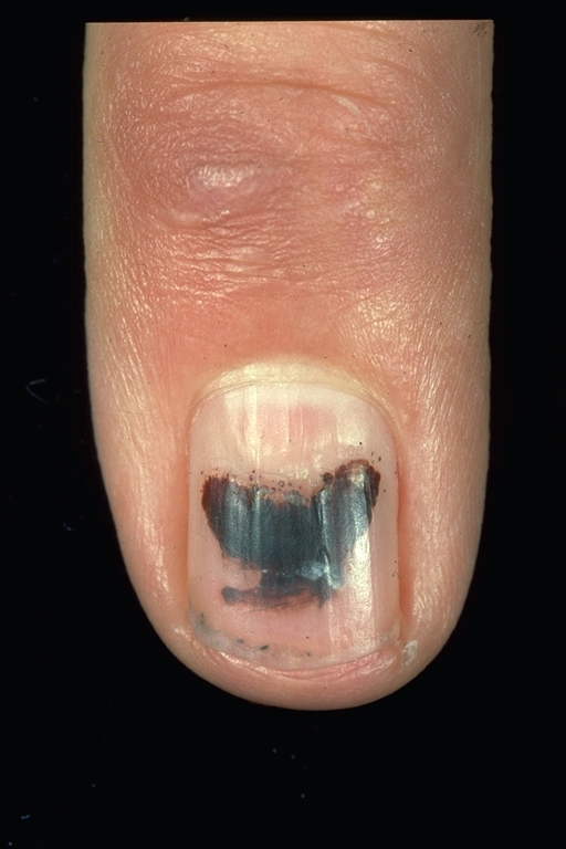 Dark Lines Under Fingernails Melanoma at Gary Poole blog