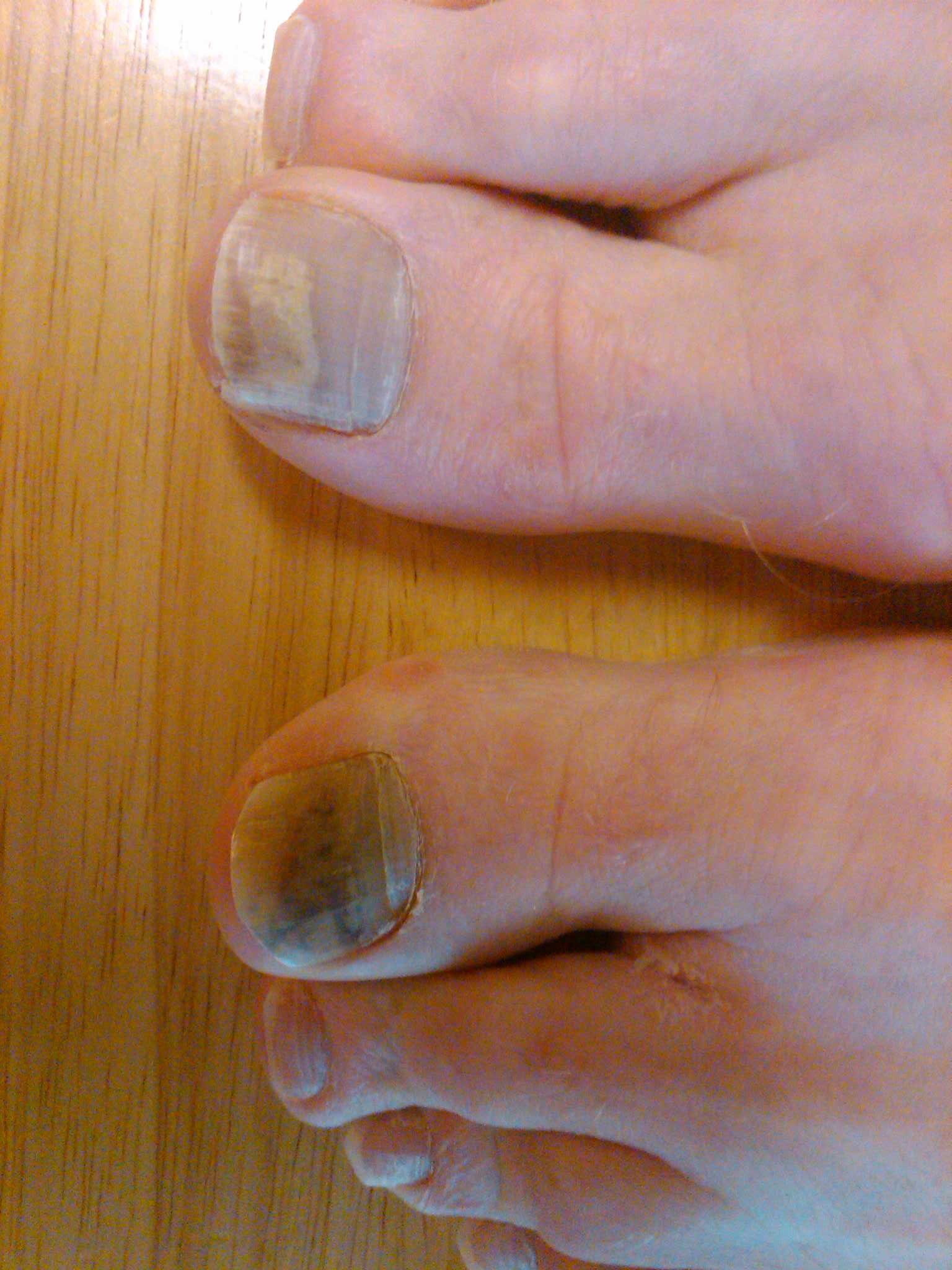 melanoma-under-toenail-pictures-black-spot-nail-melanoma-pictures