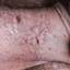 17. Genital Herpes Symptoms Pictures