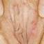 22. Genital Herpes Symptoms Pictures