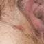 25. Genital Herpes Symptoms Pictures