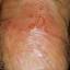 28. Genital Herpes Symptoms Pictures