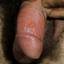 30. Genital Herpes Symptoms Pictures