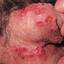42. Genital Herpes Symptoms Pictures