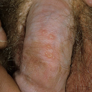 Genital Herpes Symptoms in Men