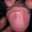 24. Genital Herpes Symptoms in Men Pictures