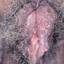 13. Female Genital Herpes Pictures