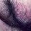 4. Female Genital Herpes Pictures