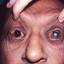 12. Hansen's Disease Pictures