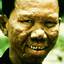 27. Hansen's Disease Pictures