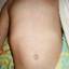 13. Roseola Pictures