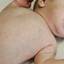 16. Roseola Pictures
