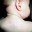 18. Roseola Pictures