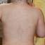 20. Roseola Pictures