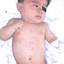 21. Roseola Pictures