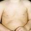27. Roseola Pictures