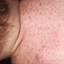 28. Roseola Pictures