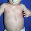 30. Roseola Pictures