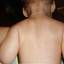 4. Roseola Pictures